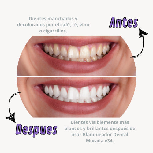 Blanqueador Dental - SmileKit