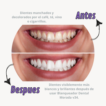 Blanqueador Dental - SmileKit